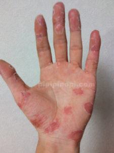 掌蹠膿疱症の治療方法