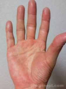掌蹠膿疱症バスソルト療法で完治