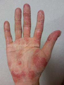 掌蹠膿疱症原因