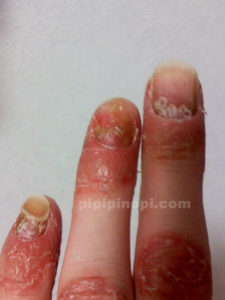 掌蹠膿疱症爪変形