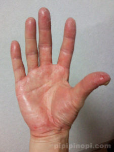 掌蹠膿疱症画像手