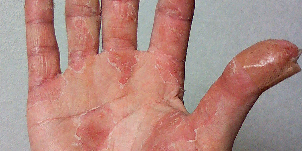 掌蹠膿疱症完治までのブログ