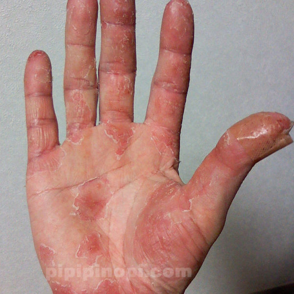 掌蹠膿疱症の完治ブログ